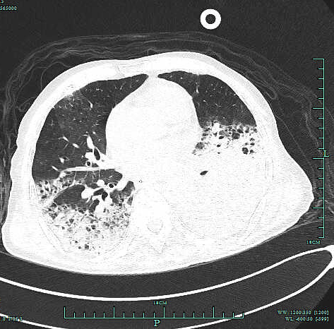 检查|【新闻快递】呼吸重症监护室成功开展两例危重症患者“床旁超声引导下经皮肺穿刺组织活检术”