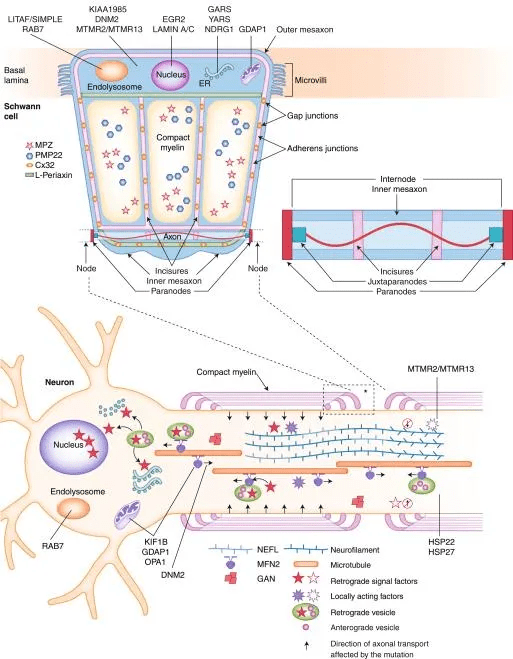 症状|肌肉萎缩、腰疼及神经根肥大原来是这种病！切记