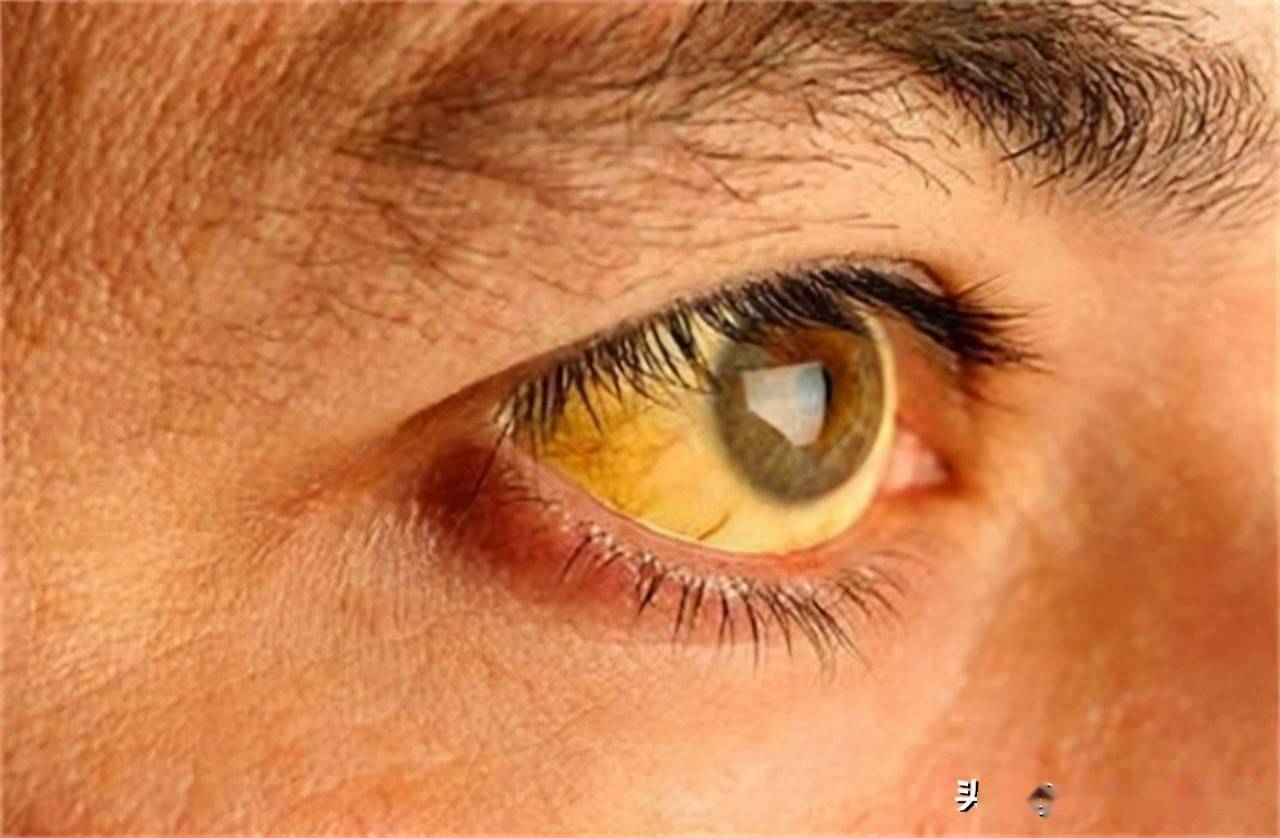 如果患有肝癌,肝脏功能受影响,凝血功能发生障碍,皮下会出现青紫瘀斑