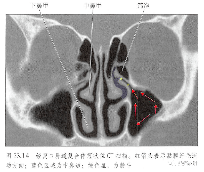 窦口鼻道复合体图片