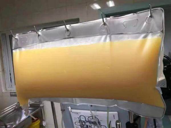 体检|这些习惯你有吗？男子体检抽出2升油浆