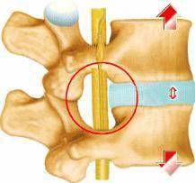 腰部|什么是腰椎间盘突出？突出的到底是什么？