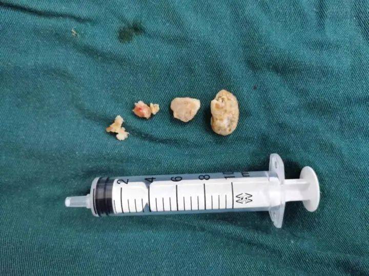 手术|男子关节里居然长出“鹅卵石”！医生这样说