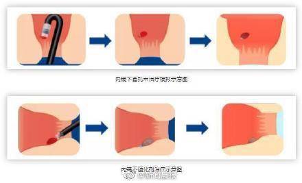 血液|蹲坑玩手机易成有痔青年