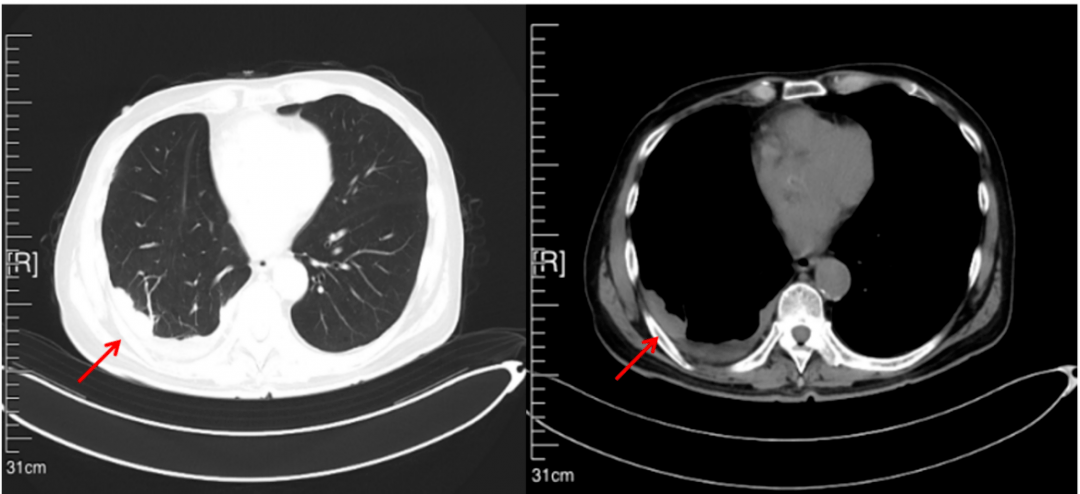 典型胸膜增厚ct图片图片