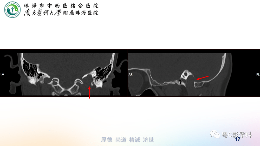 乙状窦解剖图ct图图片