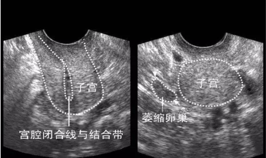 各時期正常女性生殖器官的超聲聲像表現!_子宮