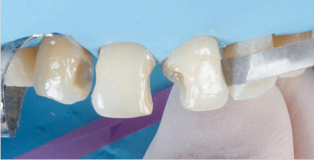 树脂配色极简法则 超实用的美学树脂配色方案,前牙多颗树脂美学实用