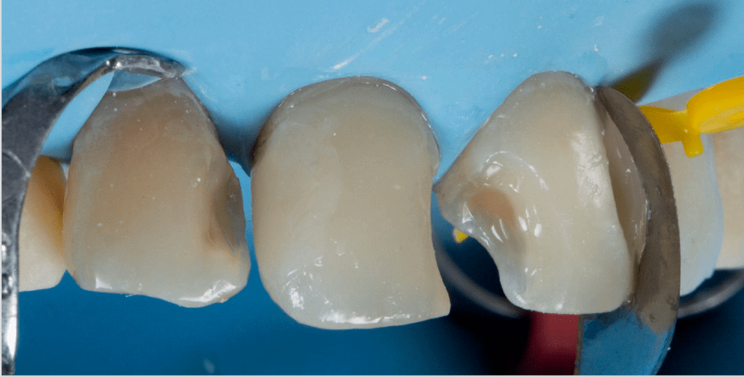 形成牙体外形壳使用低透明树脂松风a3o充填11,21牙本质区域使用中等