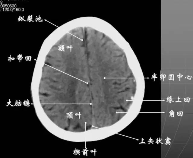 头颅ct怎么看图解正常图片