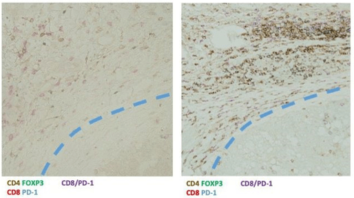 Treg|免疫治疗前用TACE铺路，或是肝癌治疗的全新妙招！