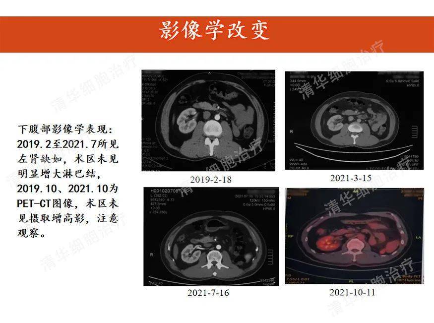 肾癌检查报告图片