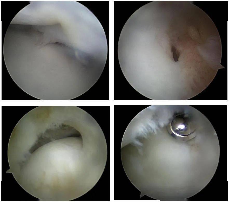 击剑运动员腕关节镜下检查及处理tfcc损伤