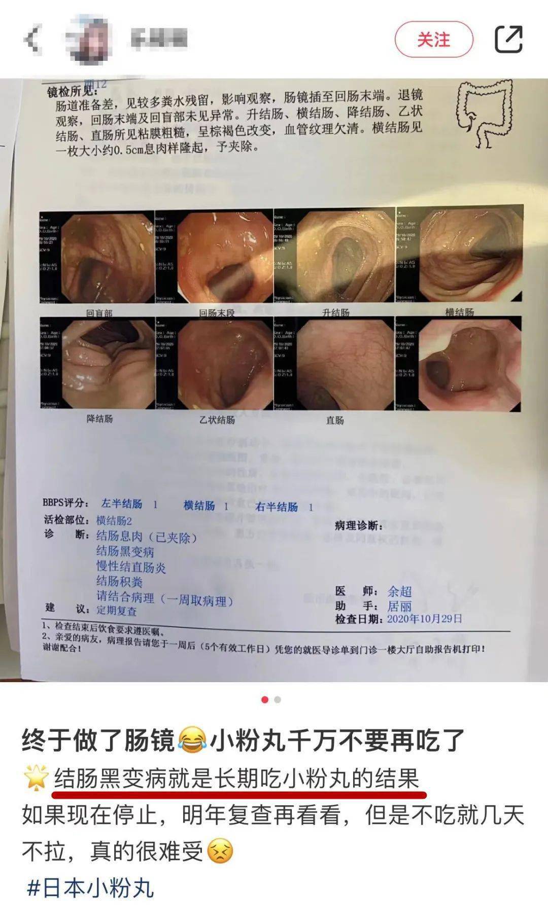 直肠黑变病图片