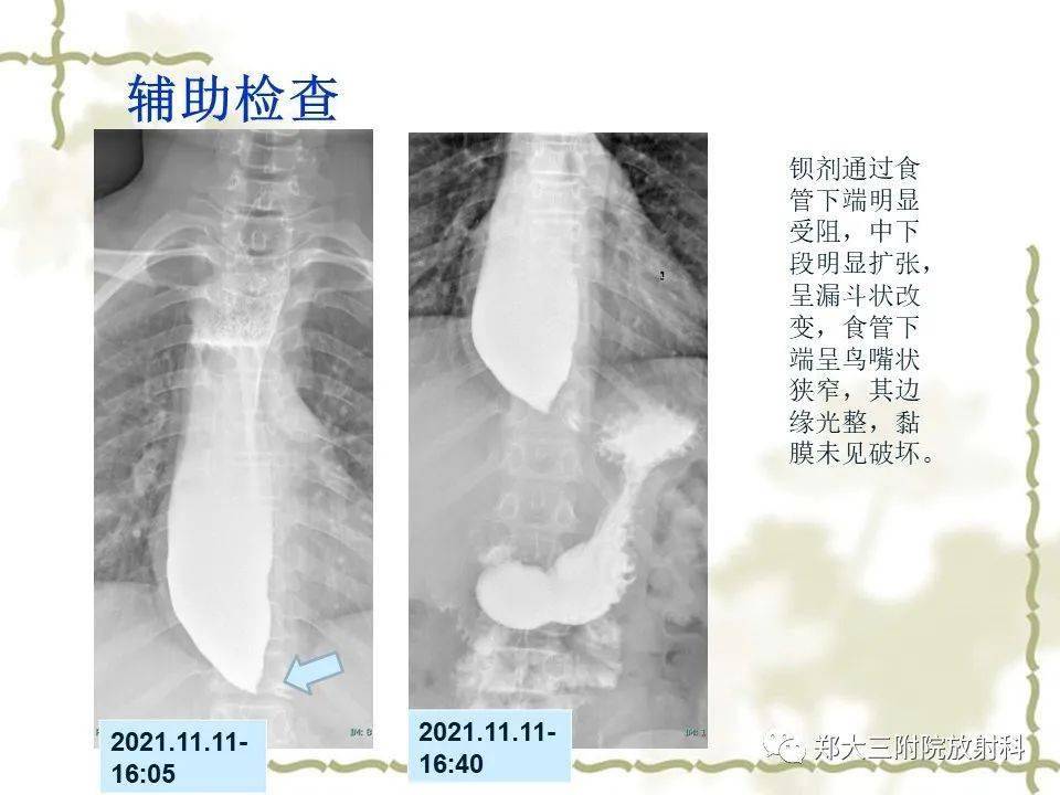 贲门失弛缓症影像图片图片