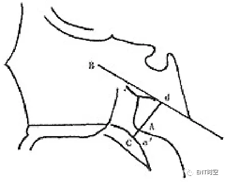 通过x线,测量「腺样体肥大」的4种方法_宽度_软腭_&gt