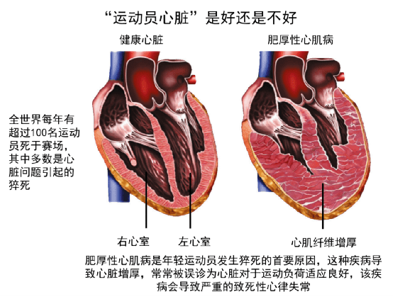 67跑步太拼已成為跑圈潮流最新研究揭示長期大強度運動對心臟的風險