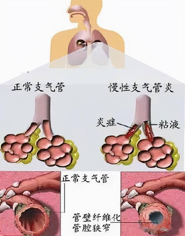 「慢性支气管炎科普」慢性支气管炎的中医防治和调理