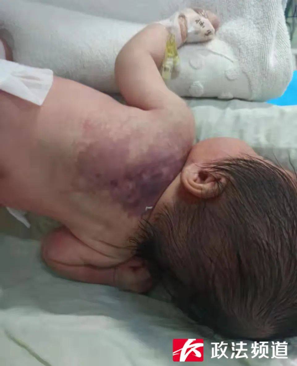 9公斤,婴儿确诊卡梅综合征!