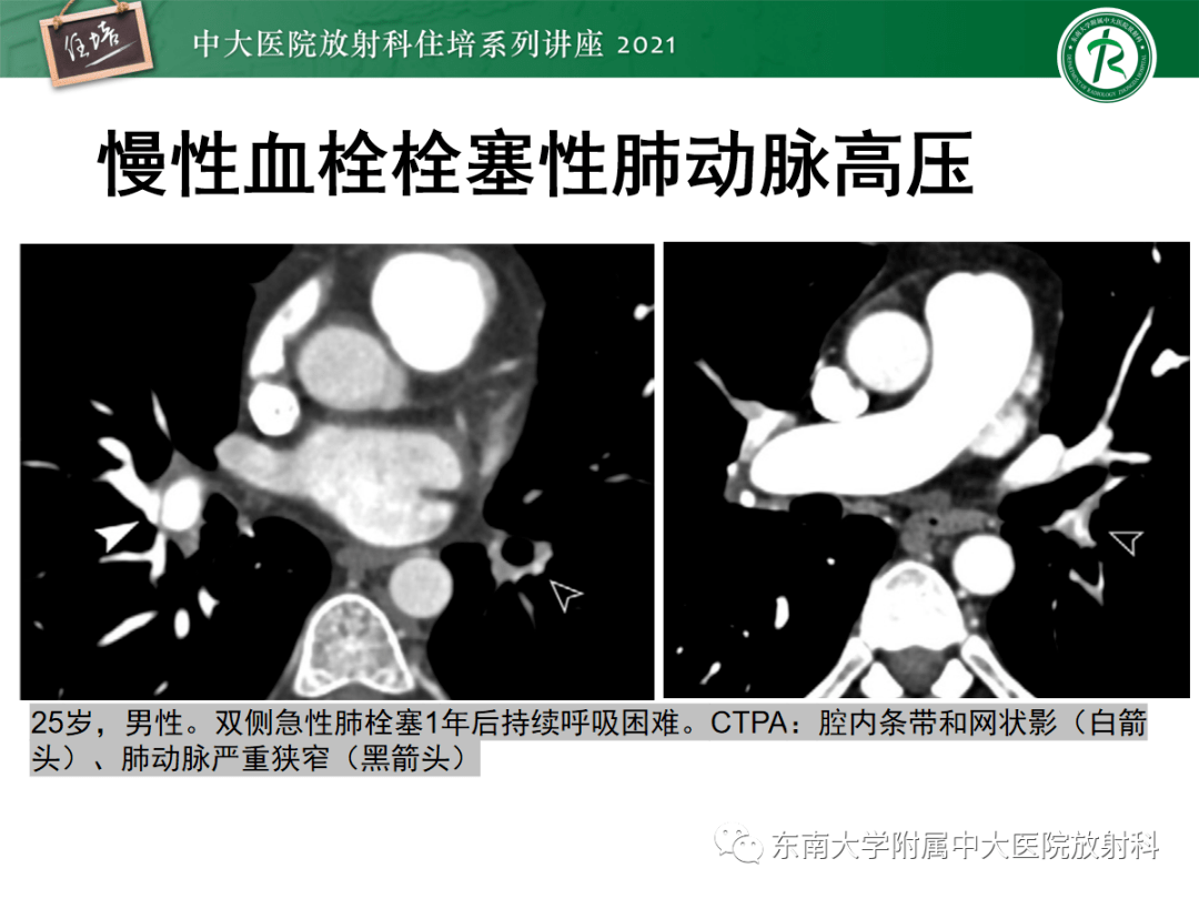 肺动脉高压的影像评估