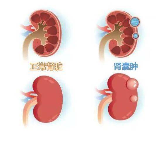 小南话科普不用开刀只需一根小细针轻松消灭肾囊肿