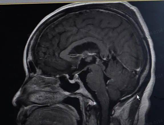 女子|女子吃了冰箱里的饭，高烧42℃，险丧命！只因忽视了它