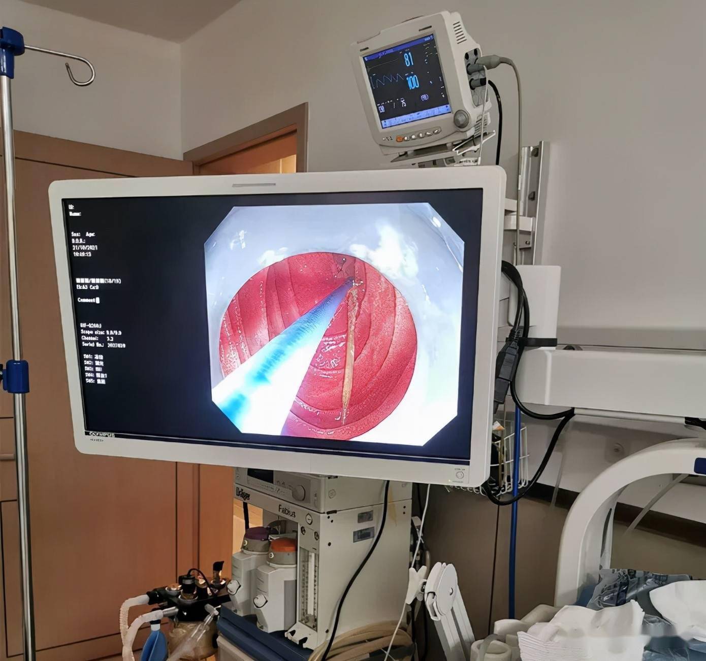 手术|震惊！女子腹痛难忍，竟是醉酒后误吞了它，结果悲剧了……