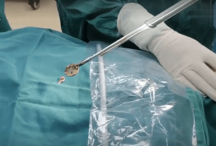 文建美|2岁男童咳嗽一周 竟是硬币卡喉 父母学会这些关键时刻能救命