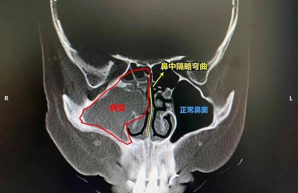 正常人的鼻中隔图片图片