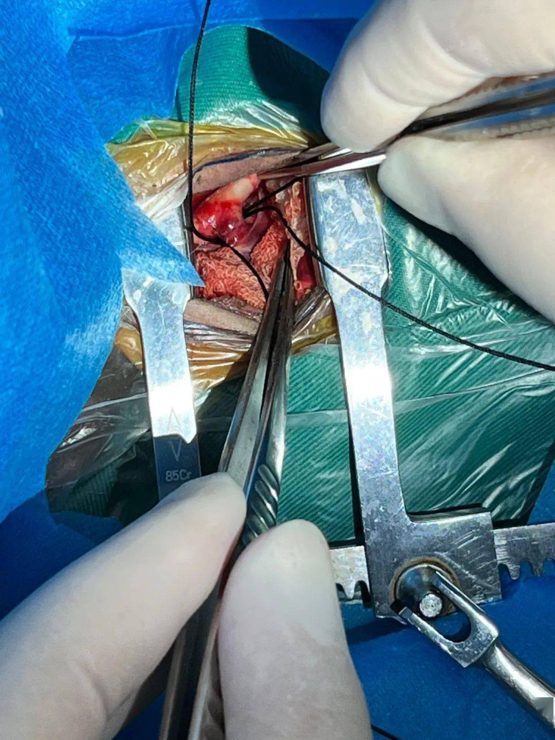动脉导管未闭手术图片