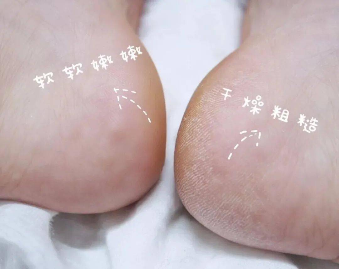 草本植物脚跟开裂、老茧、死皮……又疼又丑！用它一抹，双脚嫩滑，实测惊呆了！