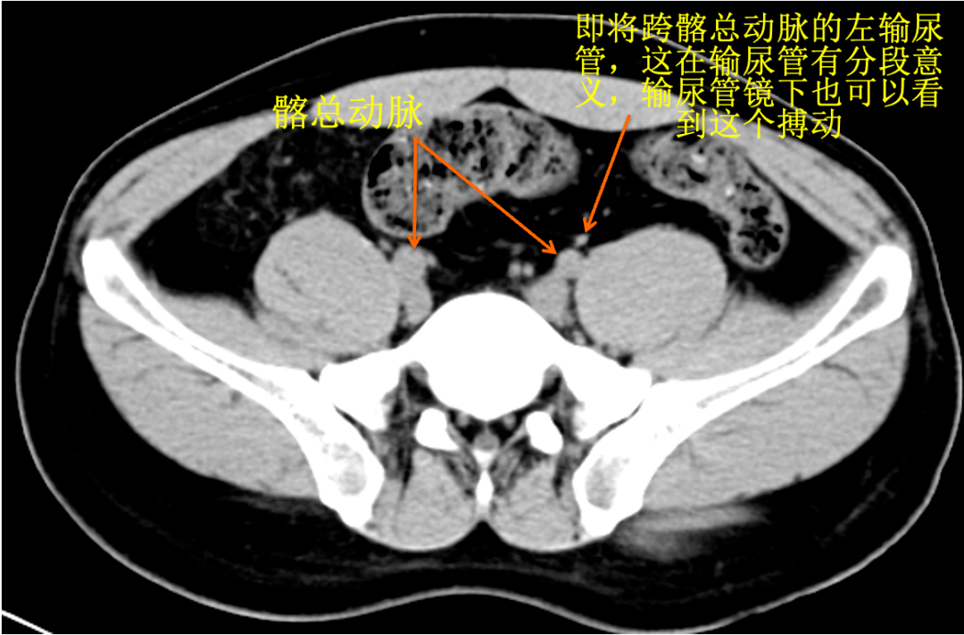 raus專欄|經腰手術體表標誌05_定位_解剖_最高點