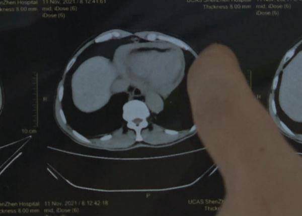 手术|男子胸痛两年没重视，差点被体内“定时炸弹”夺命