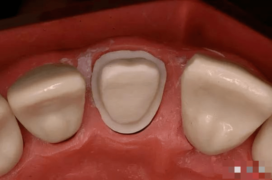 全瓷冠备牙时容易被牙医忽视的四个问题