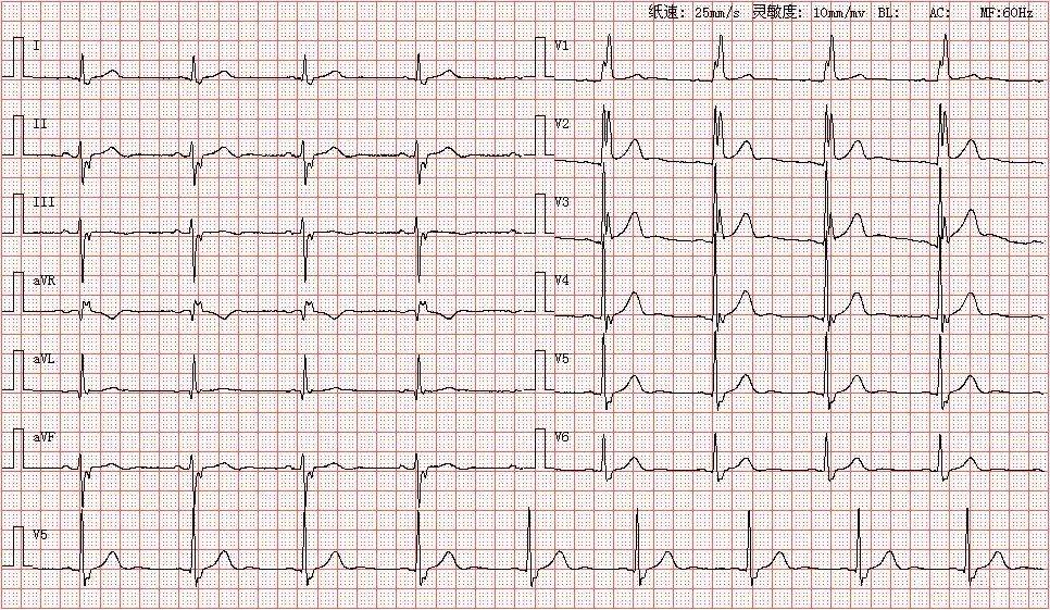 心电图库丨完全性右束支阻滞系列_窦性_心律_avr