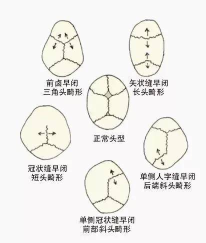 图片来自网络总结:给新生儿睡头型还是越早越好,因为刚出生的孩子头骨