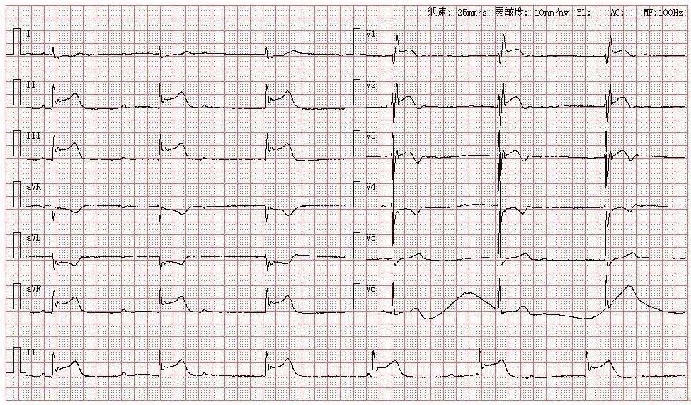 心电图库丨三度房室传导阻滞系列