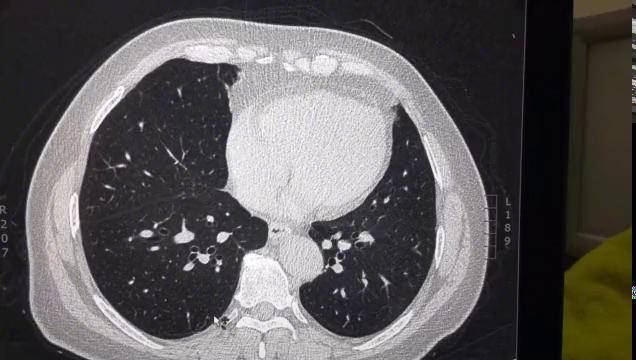 一例良性肺结节的影像学表现看一眼让你过目不忘