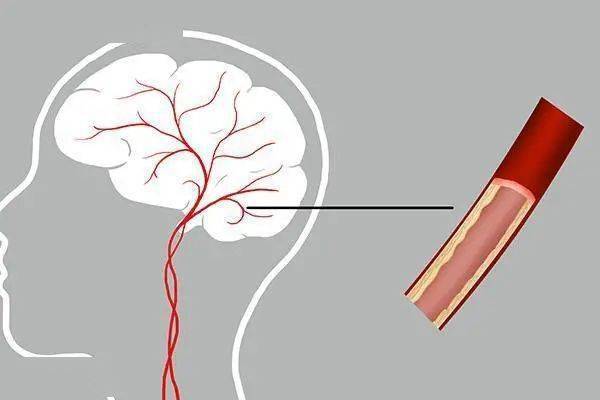疾病|脑供血不足 会向身体发出哪些“指示”？