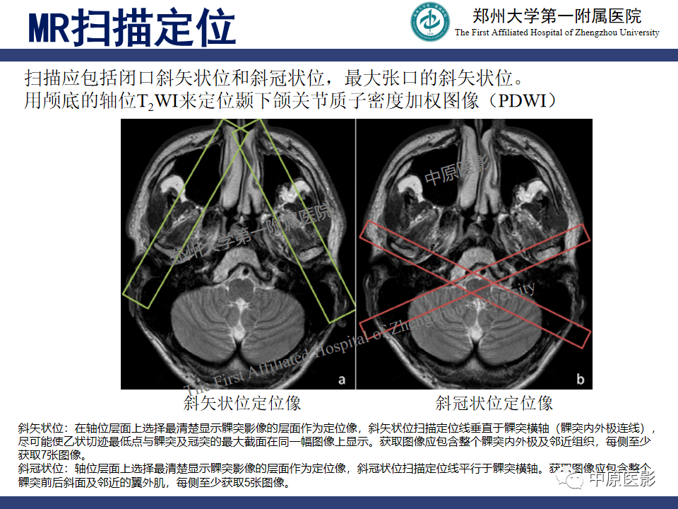 颞颌关节紊乱病的mri诊断