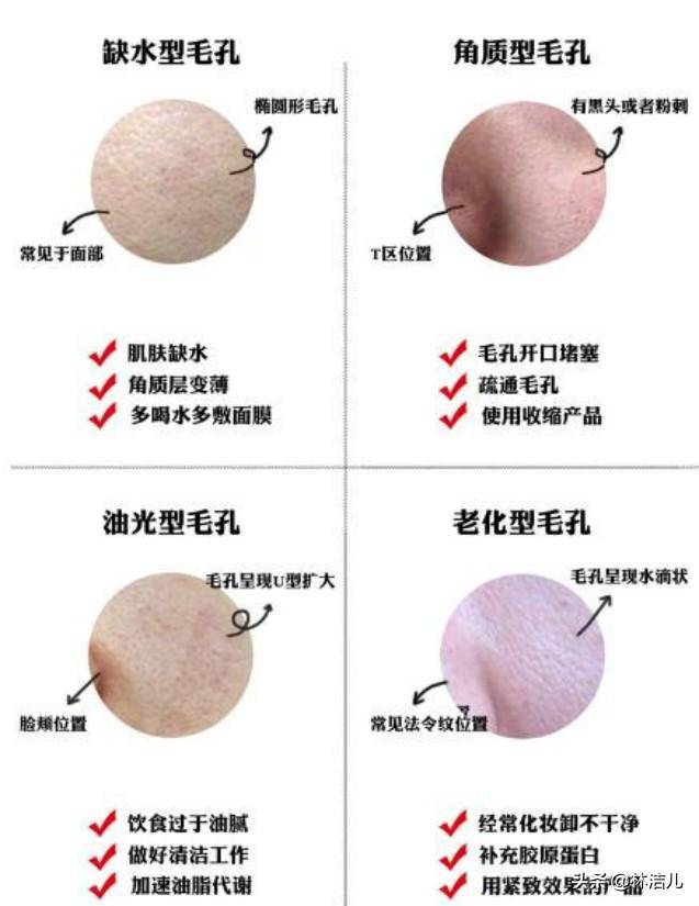 毛孔。这种情况的话，护肤已经难以改善，可能就需要用到医美的方式了。