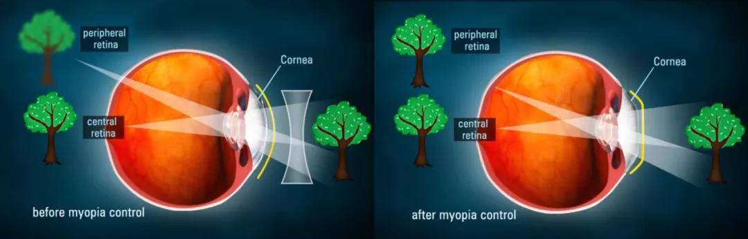 孩子都近视了,家长还不知道什么是角膜塑形镜?