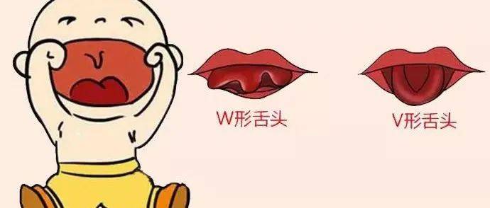 宝宝舌系带过短，剪还是不剪？做手术的最佳年龄？_孩子_发音_影响