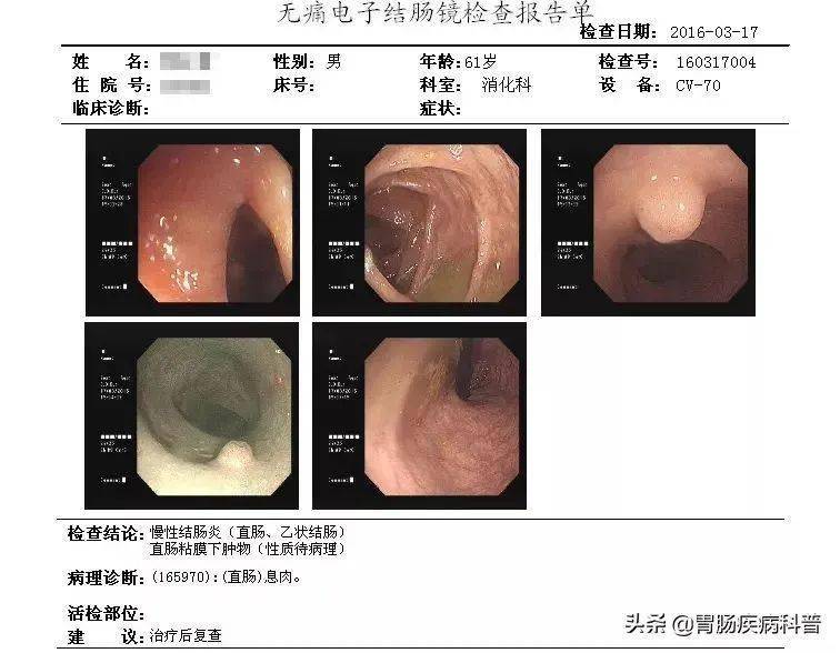 自己怎么检查直肠癌 86c0fc7aa3b94582af841744026dd7ba.jpeg