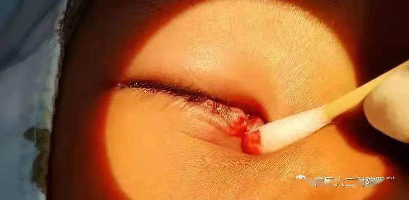 好险患儿泪小管断裂我院眼科成功救治