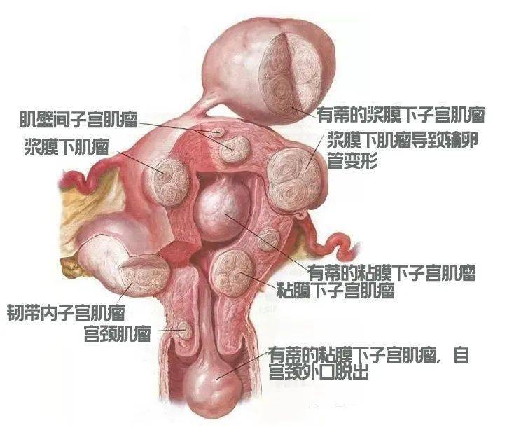 子宫前壁肌层肌瘤图片图片