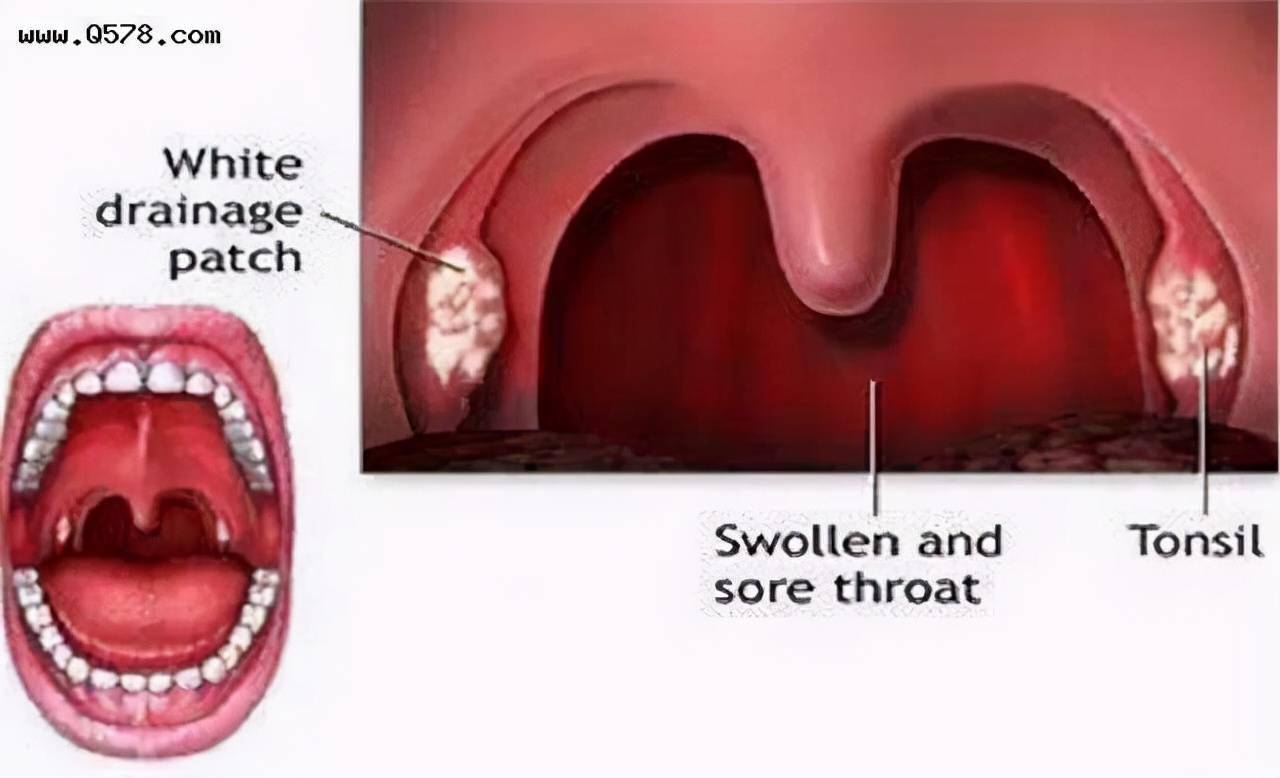 以为是慢性咽炎