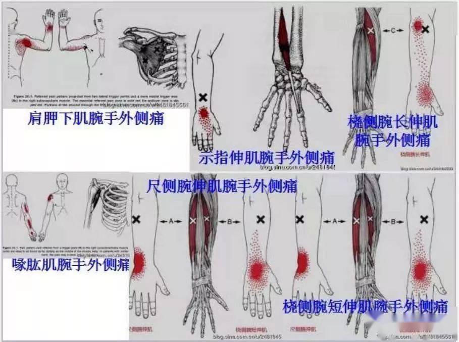 肌筋膜全身160个疼痛触发点