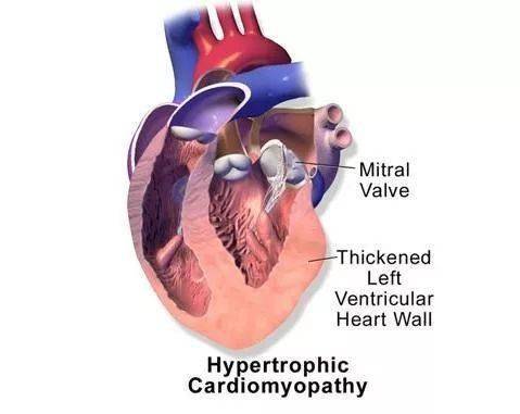 运动性猝死是怎么回事?马拉松跑者重点注意事项!_比赛_心脏_死亡