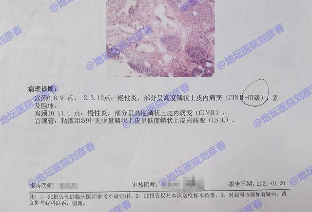 12点慢性炎,部分呈高度鳞状上皮内病变(cin2-3级),累及腺体.